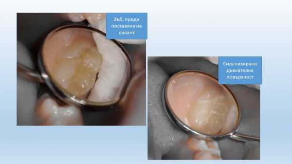 Поставят безплатно силанти на първите постоянни зъби на децата от 5 до 8 г. в Софийска област